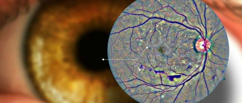 Diagnos (ADK.V) uses AI and telemedicine to scan your eye for health issues in 16 countries
